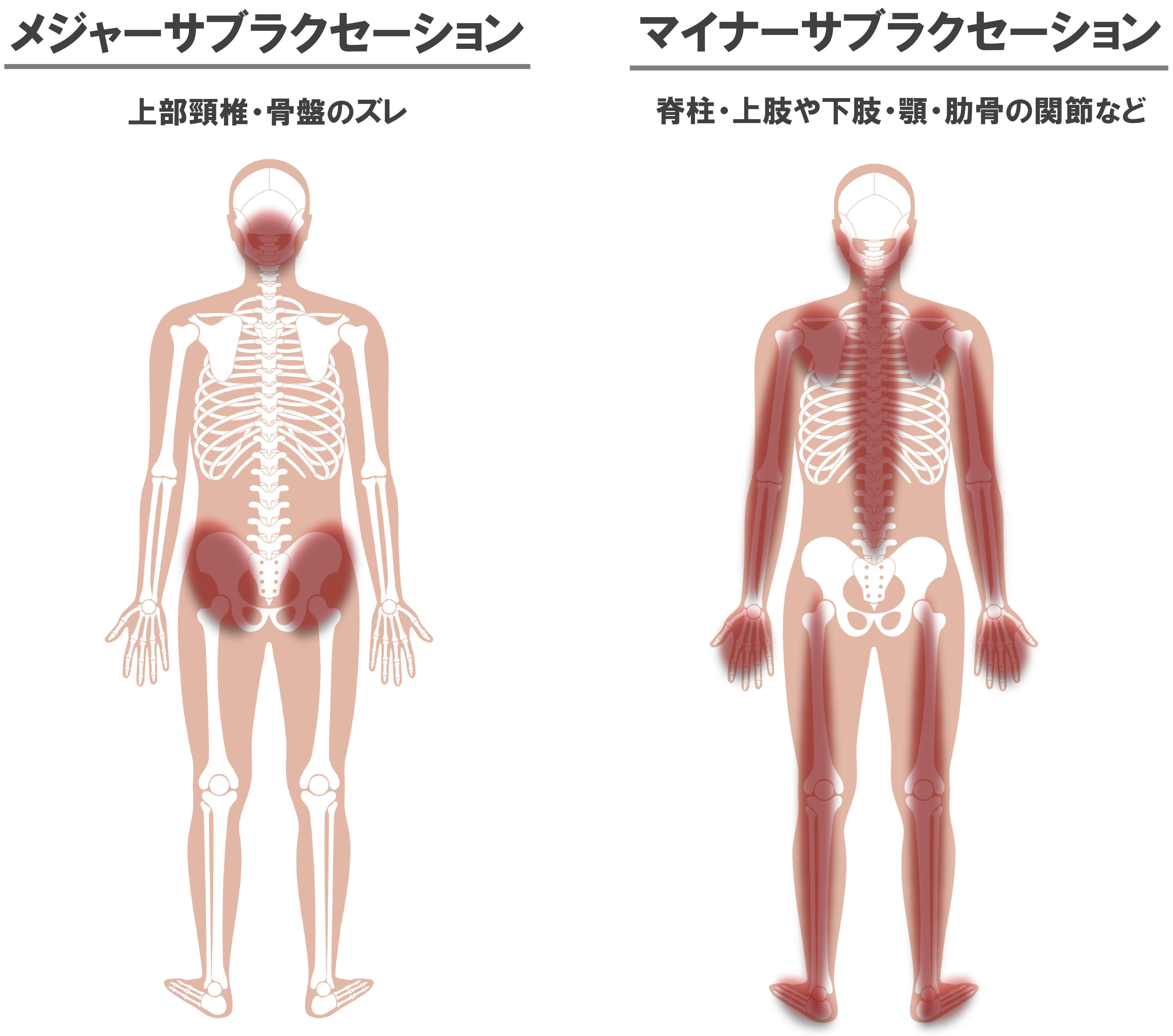 メジャー・マイナーサブラクセーション